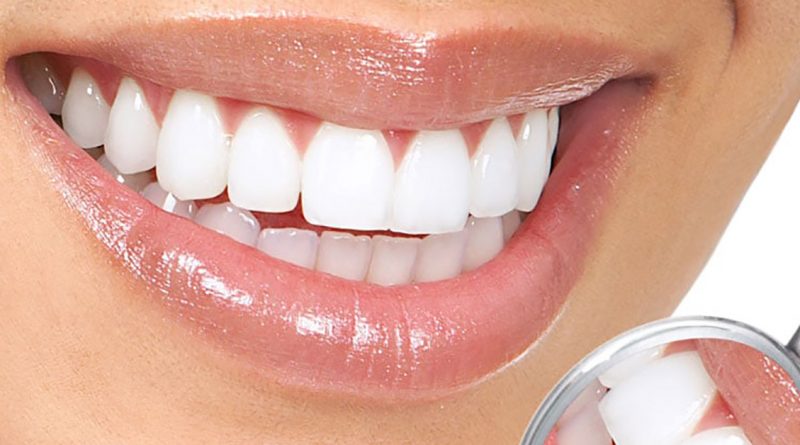Зубные камни – почему они появляются и как их удалить?